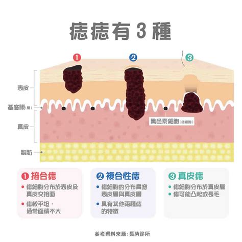 為何會長痣|痣變大、痣多或長毛會變皮膚癌？認識痣的形成與原因